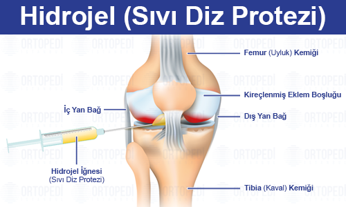 Sıvı Diz Protezi (Hidrojel) Tedavisi: Detaylı ve Samimi Bir Rehber